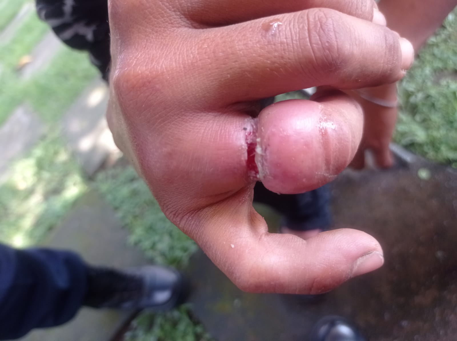Evakuasi Cincin Tersangkut di Jari